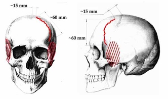 Примерное расположение трещины лобной кости Рустема Слободина